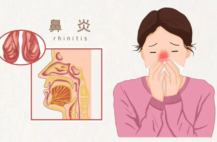 过敏性鼻炎又到高发季！该如何预防？
