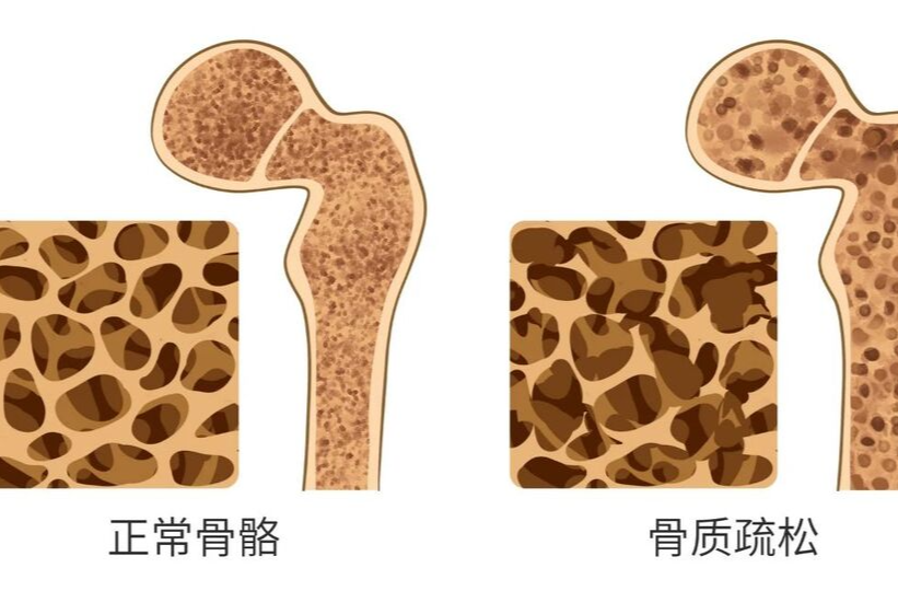 四类人建议做骨密度检查 | 科普时间