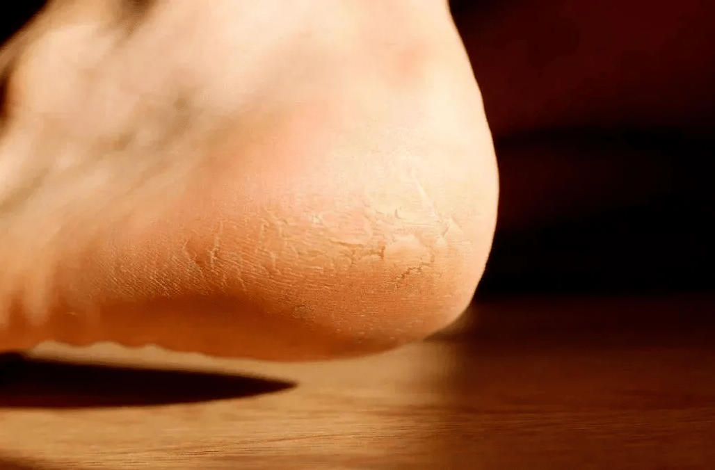 周末·健康丨脚后跟总开裂起皮？小心这几种疾病