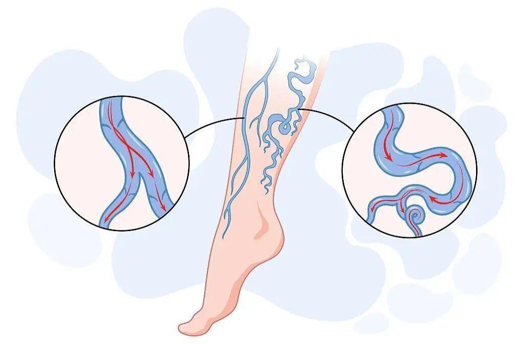 周末·健康丨血管堵不堵 看脸和腿就知道？6个信号别忽视
