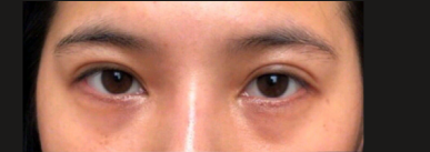 有黑眼圈怎么办？CA玻色因抗皱眼霜，帮我告别8年重度黑眼圈