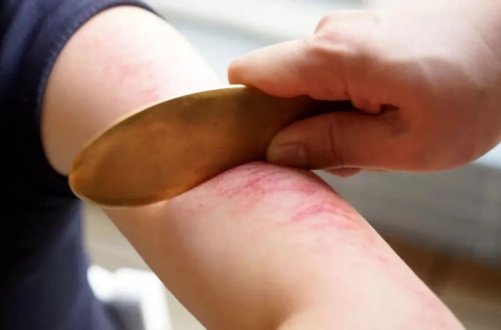 夏季多运动、多出汗能排毒？刮痧、拔罐能防脑梗？……是真是假？｜谣言终结站